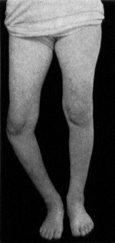 Figure 1 a. Preoperative picture of the patient at the age of 13 years, showing pronounced varus deformity of her right leg.