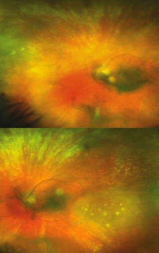 FIGURE 2. (Case 2) Top - White dots overlying widespread ischaemic retinitis. Bottom - A new area of retinitis with overlying white dots strongly suggesting syphilitic retinitis.