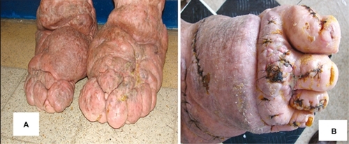 Figure 1 Before and after reconstruction surgery of the foot and toes.