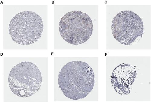 Figure 13 Immunohistochemistry analysis of CCNA2 expression in breast cancer samples. Data were obtained from the human protein atlas. (A) Protein levels of CCNA2 in tumor tissue (staining: Low; intensity: week; quantity: <25%). (B and C) Protein levels of CCNA2 in tumor tissue (staining: Medium; intensity: strong; quantity: <25%). (D–F) Protein levels of CCNA2 in normal tissue (staining: not detected; intensity: negative; quantity: none).