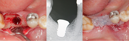 Figure 7 Initial drilling showing vital bone (A), periapical radiograph after implant installation (B) and application of the blue®m oral gel in the immediate post-operative (C).