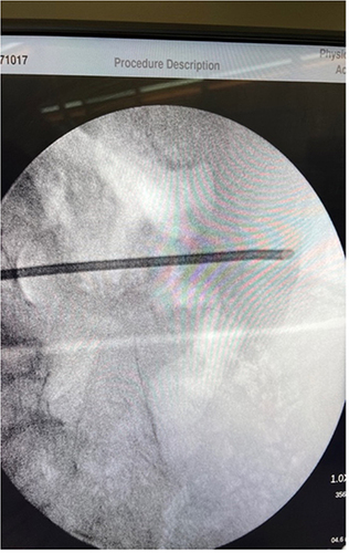 Figure 3 6-inch, 13-gauge introducer Tuohy needles placed over the iliac crest via fluoroscopy (30-degrees).