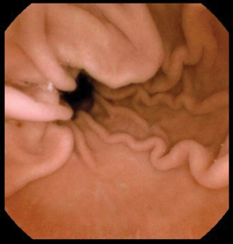 Figure 4. NaviCam image of gastric body and pylorus.
