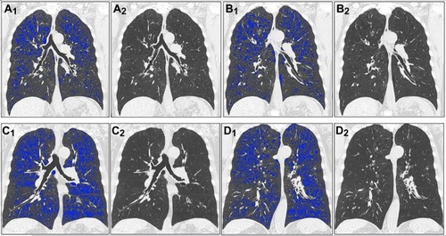 Figure 2 An example of emphysema heterogeneous distribution on full-inspiration (A–D). The blue colored area showed pixels of <-950HU, suggestive of emphysema. (A,B) were the different coronal slices of the same patients (not same with C,D). (A1,A2) were the same coronal slice and (B1,B2) were the same coronal slice. FEV1 (L)= 2.18, FEV1(%pred)= 71%, FVC (L)= 3.67, FEV1/FVC= 59%, IC/TLC= 40%. (C,D) were the different coronal slices of the same patients. (C1,C2) were the same coronal slice and (D1,D2) were the same coronal slice. FEV1 (L)= 0.74, FEV1(%pred)= 30%, FVC (L)= 2.16, FEV1/FVC= 34%, IC/TLC= 20%.