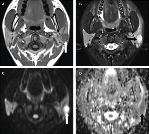 Figure 5 Tuberculosis of the right parotid lymph node in a 58-year-old female.
