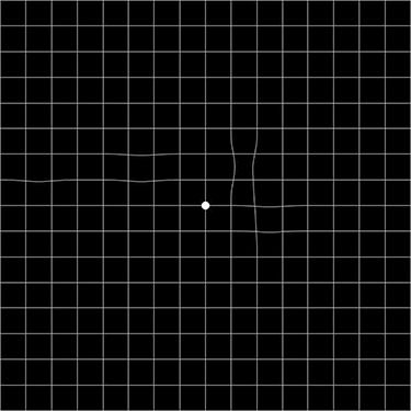 Figure 2 An image produced by the AMD-A Metamorphopsia software. The distorted image is fixed monocularly and can be straightened by moving the mouse. The degree and the dimension of the distorted lines or scotoma are transformed into indices.