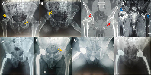 Figure 5 (A and B) Right femoral head collapsed significantly (yellow arrow), joint space narrowed, and multiple areas of low density were seen (yellow arrow) on X-ray; in the left femoral head, the shape and joint space were normal, and low-density areas (yellow arrow) were visible. (C) CT showed hyperplasia and sclerosis of the bilateral acetabular margins, uneven bone density in the left femoral head (red arrow), and a huge cavity in the right femoral head (red arrow). (D) MRI showed extra-articular inflammatory fluid, bilateral Hip joint effusion and bilateral osteonecrosis of the femoral head (blue arrow), especially on the right side. (E) Right total hip arthroplasty was performed when the inflammatory indexes normalized. (F and G) X-ray showed the left femoral head collapsed and joint space narrowed (yellow arrow). (H) No abnormalities in Hip X-ray at the follow-up in January 2022.