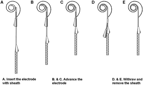 Figure 3. MRA (version 6) electrode insertion technique.
