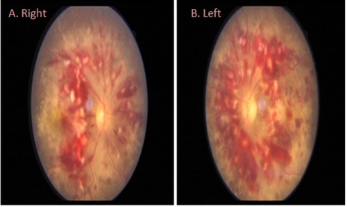 Figure 1 Fundus photograph showing blurred disc margin nasally, multiple hemorrhages, hard exudates, and cotton wool spots in both eyes. (A) Right eye. (B) Left eye.