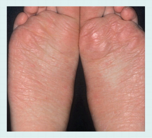 Figure 1. Tinea pedis plantaris ‘mocassin type’ in an 8-year-old girl with Trichophyton rubrum onychomycosis.Mild erythema and scaling.