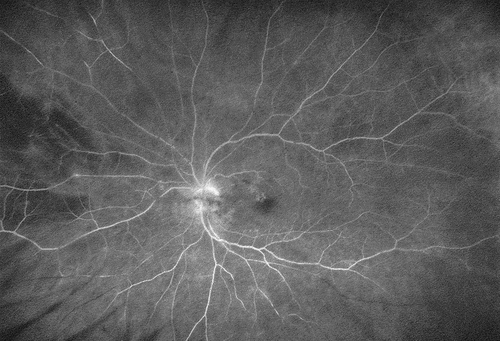 Figure 3. Eighty-four years old male presenting with foggy vision four weeks after his third Brolucizumab injection. Fluorescein angiography reveals a clinically not visible mild vasculitis and multiple vascular occlusions in the nasal and temporal inferior vessel arcades. In the absence of macular involvement, visual acuity fully recovered under intravenous corticosteroids.