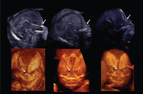 Figure 33.  Midsagittal 2D image of fetal profile and craniofacial bony reconstructed image of normal fetus (left) and trisomy 21 fetuses(middle and right) at 13–14 weeks of gestation. (left) Normal fetus. Nasal bone is clearly visualized in both 2D and 3D images (arrows). (middle) Nasal bone defect in a case of trisomy 21. Nasal bone is completely missing in both 2D and 3D. (right) Nasal bone hypoplasia in a case of trisomy 21. Small nasal bone is visualized in both 2D and 3D.