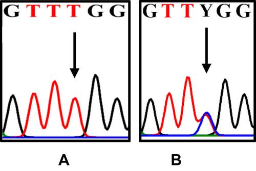 Figure 4 The differences in the DNA sequence of COL11A1. The arrows indicate T (A); double peak c.134555C/T=Y (B).