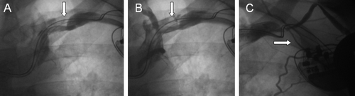 Figure 2.  Panels A and B depict a filling defect suggestive of thrombus formation (arrows) in the 6-month venography of an 81-year-old male patient implanted with a biventricular pacemaker. Late venography (C) 29 months after implantation shows complete occlusion of the axillary vein (arrow) and several new collateral vessels.