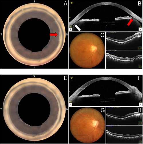 Figure 2 Angle and fundus findings before and after minimally invasive direct internal cyclopexy in case 2. (A) Preoperative 360-degree gonioscopic camera image. Red arrow indicates a post-goniotomy cyclodialysis cleft of about 45°. (B) Preoperative anterior segment optical coherence tomography (AS-OCT) in the horizontal direction confirming the disinsertion of the ciliary body from the scleral spur (red arrow) along with a shallow 360-degree ciliochoroidal detachment (white arrow). Anterior chamber-superior choroidal space traffic is not clear. (C) Preoperative fundus camera photo showing mild dilation and tortuosity of retinal veins. (D) Preoperative OCT showing chorioretinal folds, which indicates hypotony maculopathy. (E) Postoperative 360-degree gonioscopic camera image showing the cyclodialysis cleft is repaired. Scattered peripheral anterior synechiae formations after the cyclopexy are observed in the nasal angle. (F) Postoperative AS-OCT in the horizontal direction confirming the repair of the cleft and disappearance of the ciliochoroidal detachment. (G) Postoperative fundus camera image showing improvements in mild dilation and tortuosity of retinal veins. (H) Postoperative OCT showing improved chorioretinal folds and the return of the retinal shape to normal, which indicates the resolution of hypotony maculopathy.