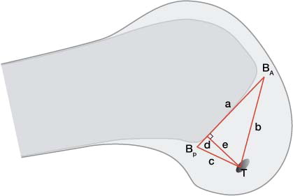 Figure 5. View of the lateral femoral condyle. The red triangle is used in the 3D visualization technique calculations. a = line equal to Blumensaat's line. BA = the most anterior point of Blumensaat's line. BP = the most posterior point. T = tunnel entrance. e = the line perpendicular to a, from the tunnel entrance. Lines b and c are the lines connecting T with Ba and Bp, respectively. This makes it possible to calculate the length of d, thus giving a percentage of the AP positioning of the tunnel position on the Blumensaat line comparable to Aglietti's method.