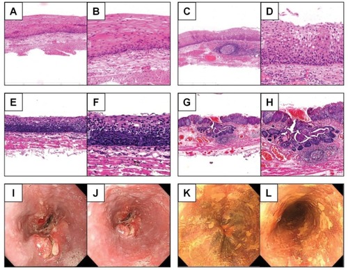 Figure 2 Representative immunological and endoscopic images of different esophageal diseases.Notes: Representative immunohistochemical images of esophageal low-grade dysplasia (A. 20×, B. 40×), esophageal middle-grade dysplasia (C. 20×, D. 40×), esophageal high-grade dysplasia (E. 20×, F. 40×), and ESCC (G. 20×, H. 40×). Representative endoscopic images of uneven surface of the esophagus (I, J) and an iodine-unstained area in the esophageal mucosa (K, L).Abbreviation: ESCC, esophageal squamous cell carcinoma.