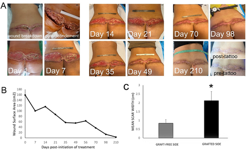 Figure 4. Treatment of a large full-thickness wound in the dorsal waistline with topical application of hypoxia preconditioned serum (HPS) obtained from the patient’s peripheral blood. (a) Image panel showing the progression of a wound healing complication in the dorsal waistline following a buttock-lift procedure in a 49-year-old female smoker. Initial wound surface area was 160 cm2. Complete wound closure was achieved at 98 days post-debridement and initiation of treatment with daily application of an emulsion containing 10% HPS. The appearance of the mature scar following laser-resurfacing is shown at 210 days, with visible difference in mean scar width between left and right side. Debridement refers to surgical excision of necrotic tissue deep-down to well-perfused layers. The number of days indicated is counted from the time point of first treatment application. Bars= 1 cm. (b) Plot showing the wound surface area, measured by image analysis, vs. time (days post-initiation of treatment). (c) Plot comparing the mean width of the final scar that formed on the graft-free left side vs. that of the skin-grafted right side. Error bars refer to standard deviation of the mean, *p<0.05.