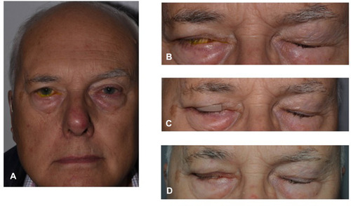 Figure 2 Moderate right VII nerve dysfunction (A) with lagophthalmos and a positive Bell’s phenomenon (B). Temporary upper lid weight to the right upper lid (C) and post implantation of a permanent gold weight right upper lid (D). The patient has provided informed consent for this image to be published.