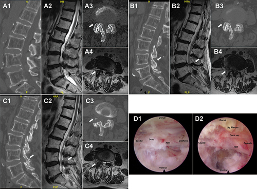 Figure 2 An illustrative case of an 85-year-old woman with lumbar spinal stenosis (LSS) who underwent ipsilateral (right-sided) reoperation. The first preoperative sagittal computed tomography (CT) (A1), sagittal magnetic resonance imaging (MRI) (A2), axial CT (A3) and axial MRI (A4). The second postoperative sagittal CT (B1), sagittal MRI (B2), axial CT (B3) and axial MRI (B4). The second postoperative sagittal CT (C1), sagittal MRI (C2), axial CT (C3) and axial MRI (C4). Endoscopy showed significant scar formation and adhesion of nerve roots and peridural area during resurgery (D1), and completion of decompression (D2).