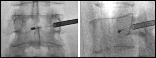 Figure 10 AP view (left) and lateral view (right) images showing final placement of bipolar radiofrequency (RF) probe in the lumbar vertebrae.