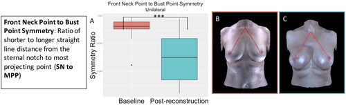 Figure 6. The front neck point to bust point symmetry significantly decreased (became more asymmetrical) for the participants who underwent unilateral implant-based reconstruction (p < 0.001). (A) Boxplot of symmetry at baseline and post-reconstruction (median and interquartile range). (B) The front neck point to bust point measurement on an exemplar patient. (C) The front neck point to bust point measurement on the same patient post-reconstruction.