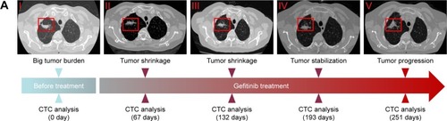 Figure 6 The relationship between acquired resistance induced by continuous gefitinib treatment and EGFR mutation.Notes: (A) Course of the disease with CT images and treatment history and driver mutation. (B) L858R and T790M mutation detection via ARMS-PCR.Abbreviations: ARMS-PCR, amplification refractory mutation system polymerase chain reaction; CT, computed tomography; CTC, circulating tumor cell; EGFR, epidermal growth factor receptor.