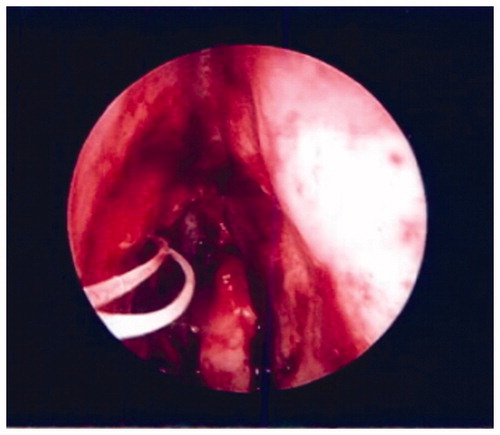 Figure 3. Postoperative image of nasal cavity following mass resection and placement of silastic stent.