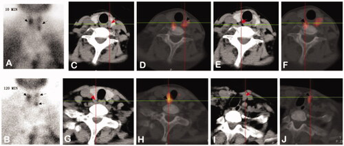 Figure 2. Images from a 28-year-old female diagnosed with SHPT. (A,B): Dual phase 99mTc-MIBI planar scintigraphy of parathyroid glands. (A) early phase (after 10 minutes post injection of tracer) – showing radioactivity uptake in thyroid with increased distribution in left lobe and upper pole of right lobe. (B) late phase (after 120 min) – activity of wash-out from thyroid and retention in hyperfunctioning parathyroid glands (upper pole and inferior pole of left thyroid, upper pole of right thyroid, black arrows). (C–H): CT alone (C/E/G) and 99mTc-MIBI SPECT/CT images (D/F/H) of the same cross-section views showing the right upper (C and D), the left upper (E and F) and inferior (G and H) hyperfunctioning parathyroid glands (arrows). (I,J): CT alone (I) and 99mTc-MIBI SPECT/CT images (J) of the same cross-section views showing a new hyperfunctioning parathyroid gland that was not found in 99mTc-MIBI planar imaging in the inferior pole of right thyroid (arrows).