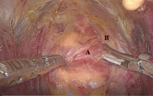 Figure 2 After the neck flap was free, and maintained using low-pressure CO2 insufflation at 5–6 mmHg. Incision of the linea alba cervicalis and dissection of the thyroid were done using the harmonic scalpel. A: thyroid gland, B: Strap muscles.