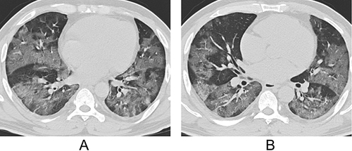 Figure 4 A 44-year-old male patient infected with the original strain. (A and B) Axial computed tomography (CT) images show patchy ground-glass opacities (GGOs) distributed peripherally of both lungs.