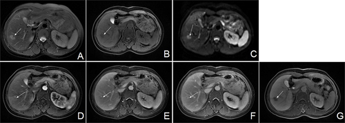 Figure 3 Magnetic Resonance Imaging before surgery. MRI showed a lesion (white arrow) with high signal intensity on T2, low signal intensity on T1, and high signal intensity on DWI in segment 6 of the liver. The lesion showed enhancement on arterial phase and faded signal on portal and delayed phases. The hepatobiliary phase showed low signal intensity. (A) T2-weighted image; (B) T1-weighted image; (C) diffusion-weighted images; (D) arterial phase; (E) portal venous phase; (F) delayed phase; (G) hepatobiliary phase. MRI, magnetic resonance imaging.