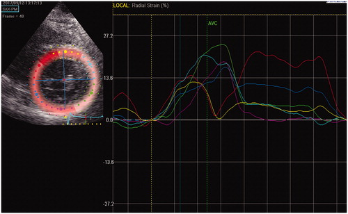 Figure 1. Echocardiographic imaging in parasternal short-axis view. The left ventricle (LV) is divided into 6 equal colour coded segments. The right hand picture demonstrates radial strain time curves. The septal LV segment (yellow dots and line) has early mechanical activation. The lateral LV segment (green) and the posterior LV segment (purple) demonstrates late and almost simultaneous timed mechanical activation which is significantly delayed compared to that of the anterior segment (blue). Since the mechanical activation of the lateral and the posterior LV segment are separated by less than 10 ms, the posterolateral segment between them is selected as target LV segment for placement of the LV lead (10). AVC=aortic valve closure.