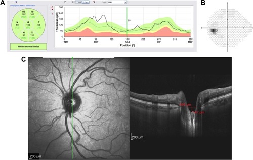 Figure 9 Structural and functional findings in a glaucomatous eye in percentile group 1 of the HVOC (mean =940 µm, mean MD =−4.70 (1.2) dB). (A) Circumpapillary RNFLT; (B) standard automated perimetry grayscale map; (C) B-scan of the largest vertical optic disc cup and length and depth used to calculate the HVOC.