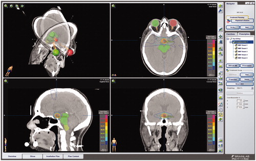 Figure 1. Example dose plan in iPlan (BrainLab) for IMRT of a craniopharyngioma, with coronal, axial and sagittal CT overlaid on MRI with gadolinium (Gd) enhancement. The target volume was defined and treated without setup margins. The eye balls, optic chiasm, nerves and tracts, and brainstem were outlined and defined as organs at risk. The prescription dose of 54 Gy was prescribed to the 90% isodose contour, and the 90% isodose contour was encompassing the target volume.