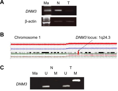 Figure 1 Analysis of specimens from a 68-year-old female with HCC.