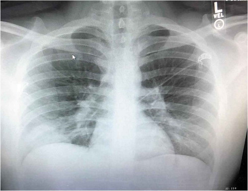 Figure 1. CXR showing hazy wedge-shaped right lung base opacity