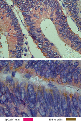 Figure 7 The high expression of TNF-α on EpCAM+ tumor cells in CRC tissue ((A) ×400, (B)×1000).