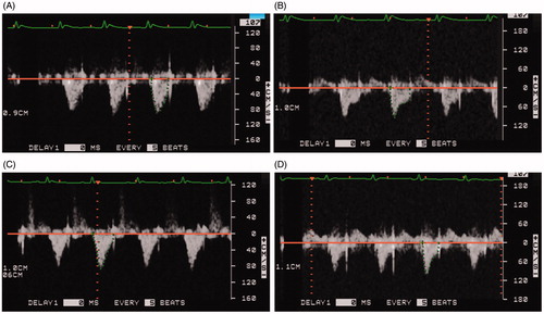 Figure 2. Cur NP treatment improves MCT-induced decrease in pulmonary artery flow. Representative image from a MCT only animal at day 1 (Panel A) and at day 28 (Panel B). Note mid-systolic notch at day 28. Images from a MCT + Cur NP treated animal at day 1 (Panel C) and at day 28 (Panel D).
