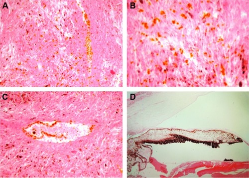 Figure 1 Distribution of gold nanoparticles (GNPs) after intratumoral injection in a human eye enucleated for uveal melanoma. Note rather diffuse infiltration of orange-colored GNPs within the sheets of tumor cells ([A and B], hematoxylin and eosin stain, magnifications ×200 and 400, respectively) and the high affinity of the GNPs for intratumoral vascular endothelial lining ([C], hematoxylin and eosin stain, magnification ×200). Image (D) represents lack of presence of GNPs in extratumoral areas such as the cornea, iris, ciliary body, and lens (hematoxylin and eosin stain, magnification ×200).
