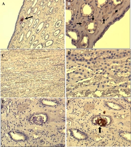 Figure 3 Immunohistochemical (IHS) staining of paraffin-embedded renal tissue by using anti-CNP monoclonal antibody. Brown color shown by black arrows indicates positive signal (existence of CNP antigen) in the tissue. The images shown at A (100X) and B (200X) are from renal plaque-positive, IHS-positive tissue. C (100X) and D (400X) are from IHS-negative tissue, E and F (200X) are consecutive sections from a positive tissue. E is stained by omitting the monoclonal antibody, showing no positive signal whereas F positively stained in one of the collecting ducts.