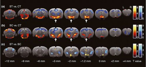 Figure 3.  Transverse slices shown from caudal (left) to rostral (right), indicating brain area with significant difference for the relative value of glucose uptake for each pair of conditions. Red and blue color indicate significantly increased and decreased glucose uptake in the former condition compared with that in the latter one, respectively (P values < 0.01; uncorrected). The statistical differences were determined by SPM using a general linear-model approach with proportional normalization and grand mean scaling. Bregma was set to the point of origin in the caudal-rostral axis according to the anatomical atlas of the rat brain (Paxinos and Watson Citation2007). Arrows indicate the position of the hypothalamus. CT, control (no IMO); ST, rats under IMO without chewing; SC, rats under IMO with chewing; n = 6 each.