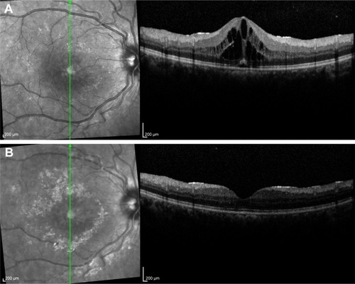Figure 3 Thirty-year-old female with Behçet’s disease showing development of macular edema on optical coherence tomography (A) and regression of intraretinal fluid 3 weeks following intravitreal injection of Ozurdex® (B).
