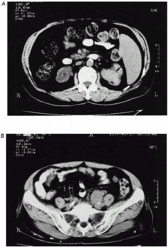 Figure 2. Noncontrast medium enhanced abdominal CT revealed: (A) a tumor mass (arrow) within dilated left renal pelvis; (B) a tumor mass (arrow head) over left common iliac chain invading psoas muscle.