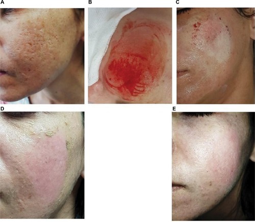 Figure 9 Treatment of acne scars with the single anterior chemabrasion technique.