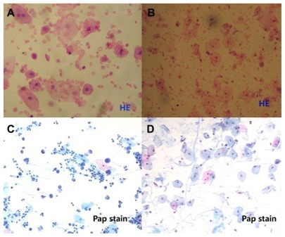 Figure 2 UC. (A and B) Hematoxylin stain, (C and D) Papanicolaou stain. (A, B and D) Three examples of normal cells and an example of tumor cells (C).