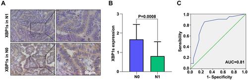 Figure 1 Low expression of XBP1s is closely related to lymph node metastasis in PTC. (A) Representative immunohistochemical staining profile of PTC tissue samples with (N1) or without (N0) lymph node metastasis. (B) The expression of XBP1s in N1 and N0 groups according to the SI of IHC. (C) ROC curve analyses to distinguish N1 patients. Differences between groups in (B) assay were analyzed by two-tailed Student’s T-test. Error bars represent means ± SD.