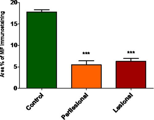 Figure 5 Graphical representation of the area percent of MIF immunostaining assessed by Image J. MIF signaling was significantly lower in skin biopsies taken from the perilesional and lesional areas than those of control subjects. Data expressed as Mean±SD. ***Indicates significance versus control group (P < 0.05).