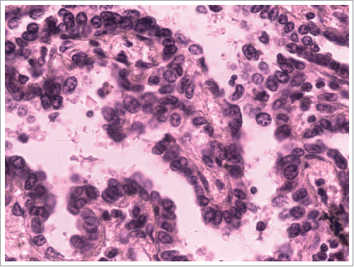 Figure 1. The pathological diagnosis of the resected specimens was lung adenocarcinoma.