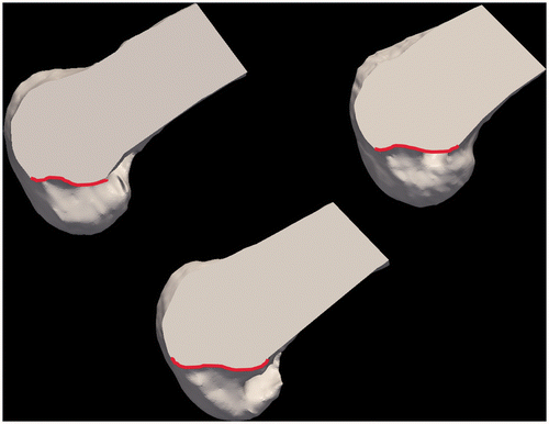 Figure 1. Three surface representations of cadaveric femurs demonstrating variability in Blumensaat's line (red) when viewed as sagittal sections looking towards the medial wall of the lateral femoral condyle.